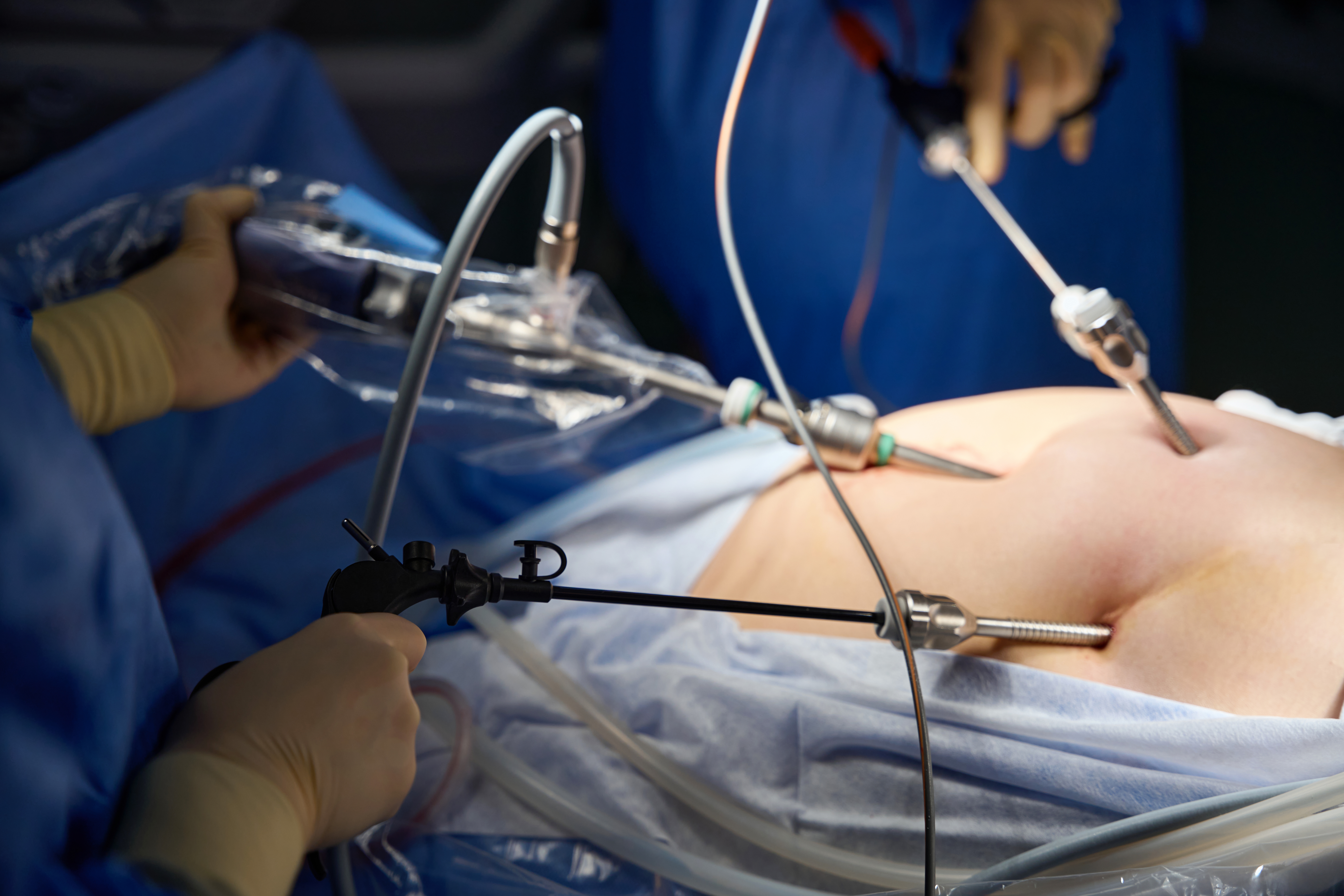 Hernia surgery information